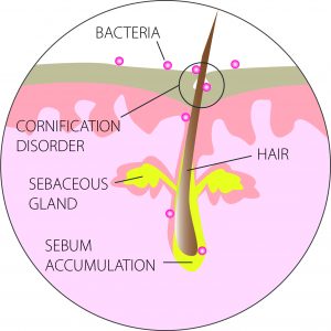 Hyperkeratosis