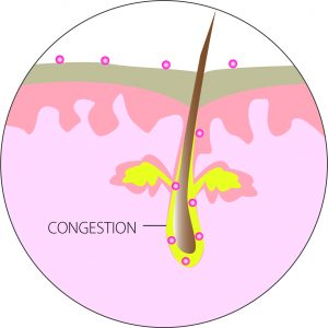 Sebum Overproduction