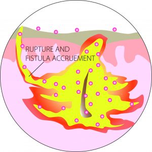 Abscess